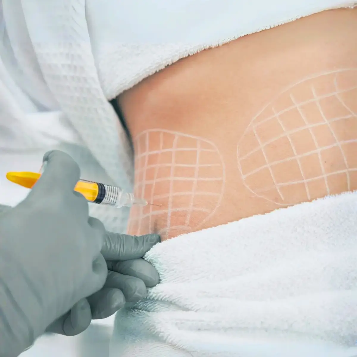 Mesoterapia Lipolítica: Reducción de Grasa Localizada | revitalis